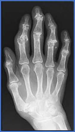 Arthrose destructrice IPP et IPD