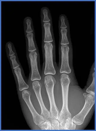 Main normale : les espaces noirs entre les phalanges correspondent à l'épaisseur du cartilage
