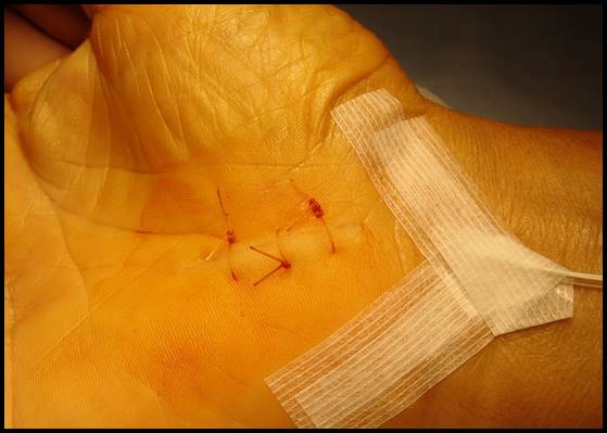 Fermeture de l'incision chirurgicale