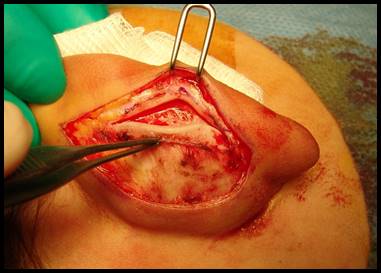 SEPARATION CONQUE / ANTHELIX par incision du cartilage