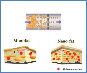 La technique nanofat est un procédé effectué UNE SEULE FOIS et dont les effets peuvent persister PLUSIEURS ANNEES