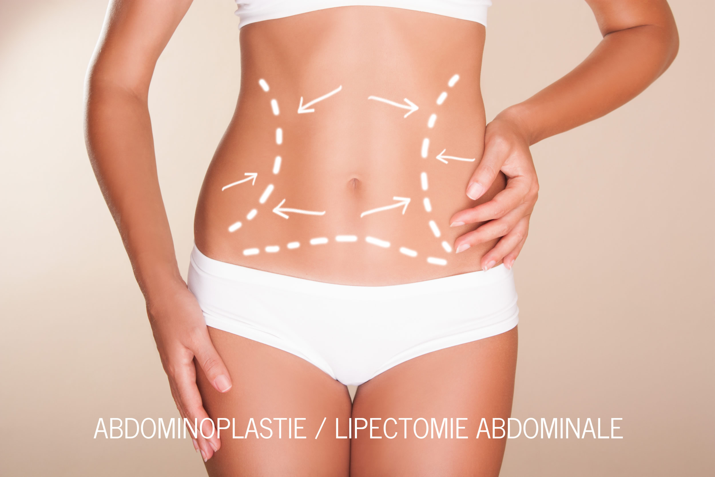 Abdominoplastie - Dermolipectomie Abdominale