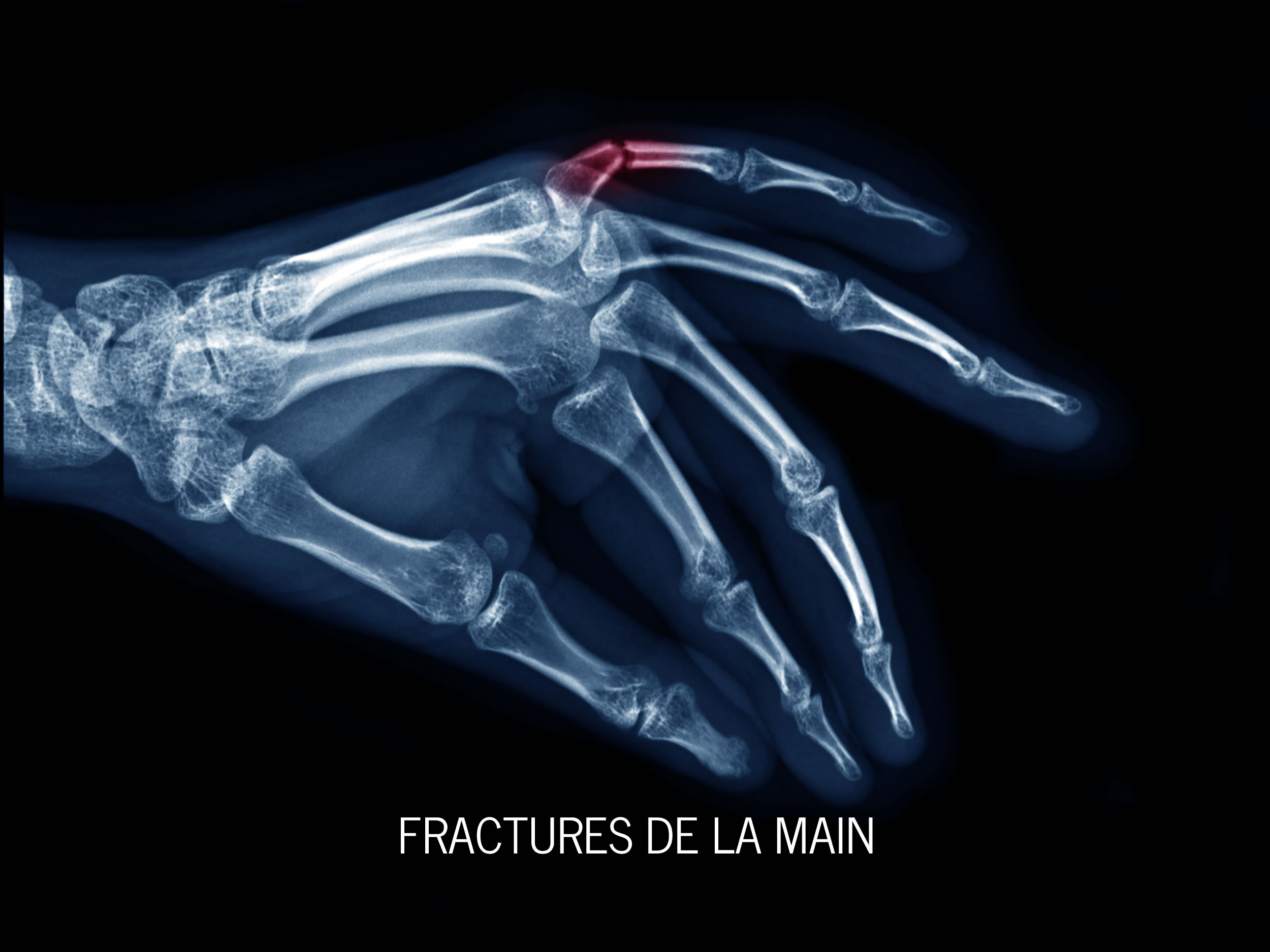Fractures de la main