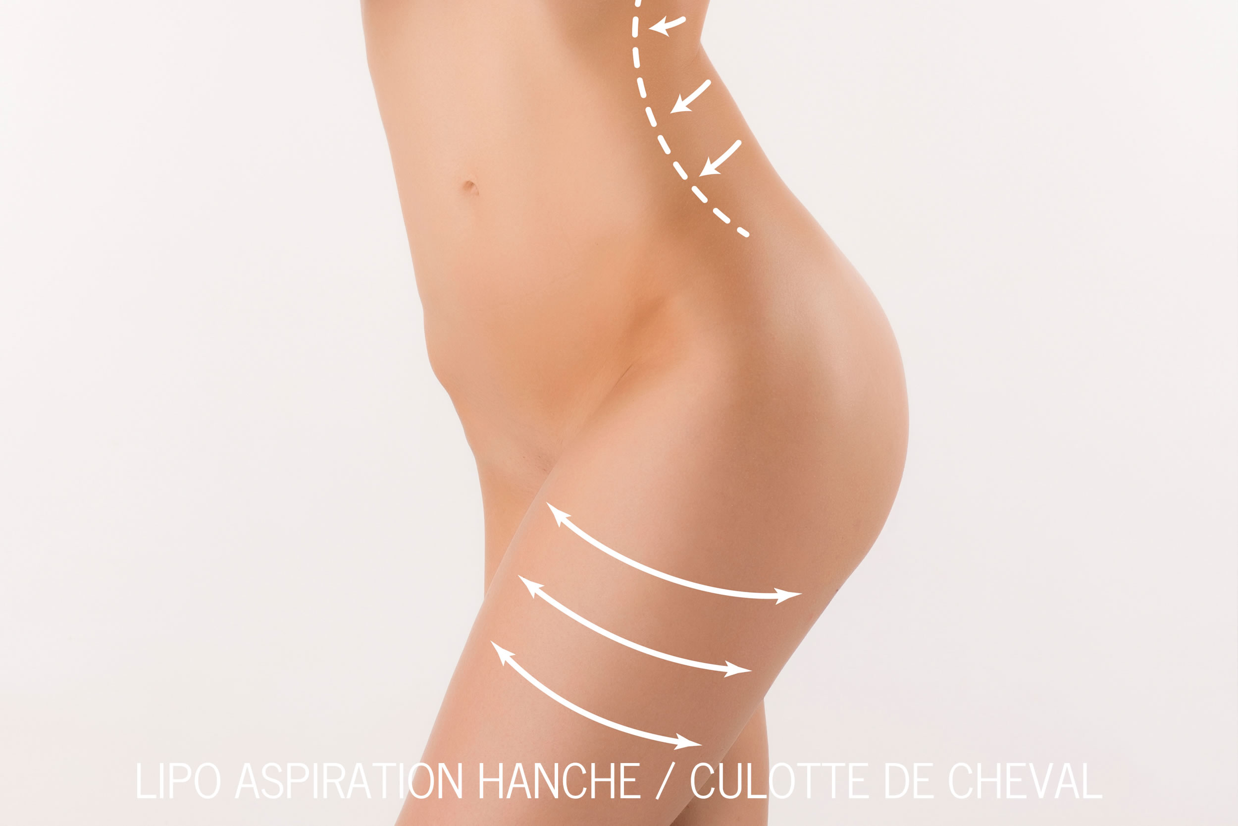 Lipo Aspiration Hanche - Culotte de Cheval